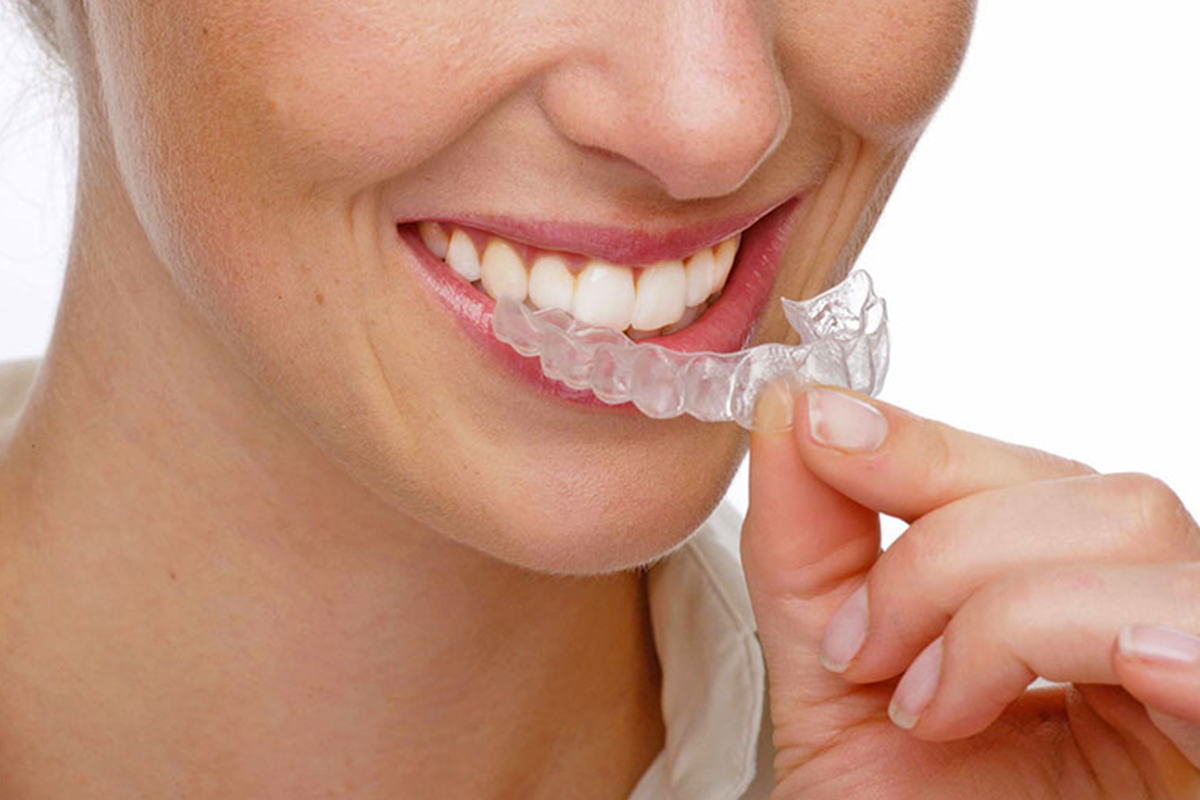 Il vostro studio tratta apparecchi ortodontici invisibili?