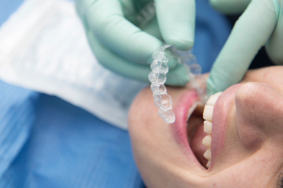 Invisalign: un nuovo modo di fare ortodonzia - 1° Parte