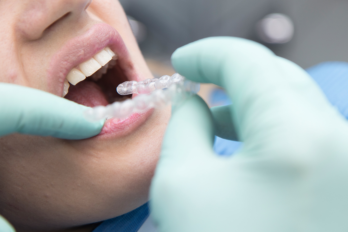 Invisalign: un nuovo modo di fare ortodonzia - 2° Parte | Studio Mario Lisa