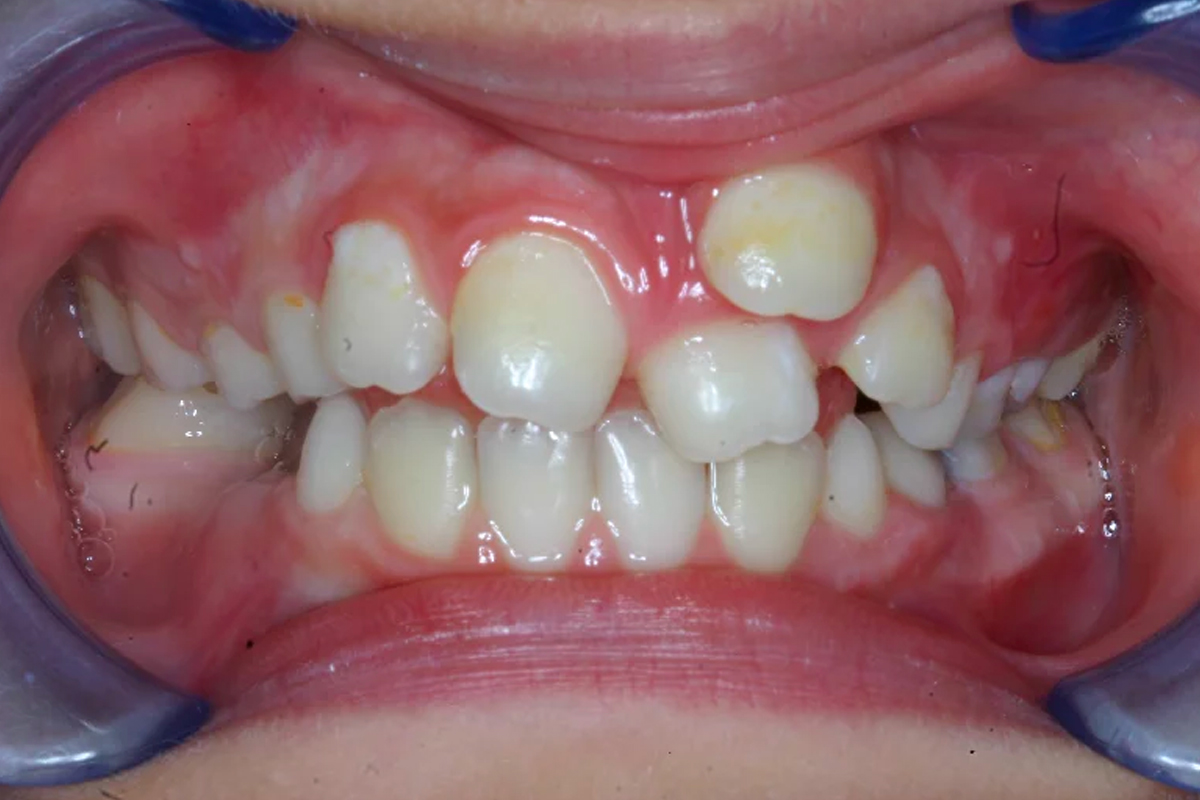 I denti sovrannumerari: come e quando si interviene?