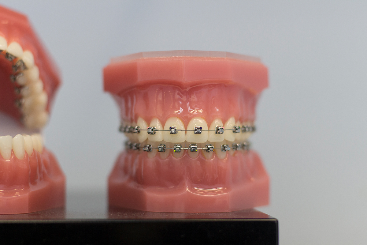 Journal of Clinical Orthodontics: metodica Damon Straightwire