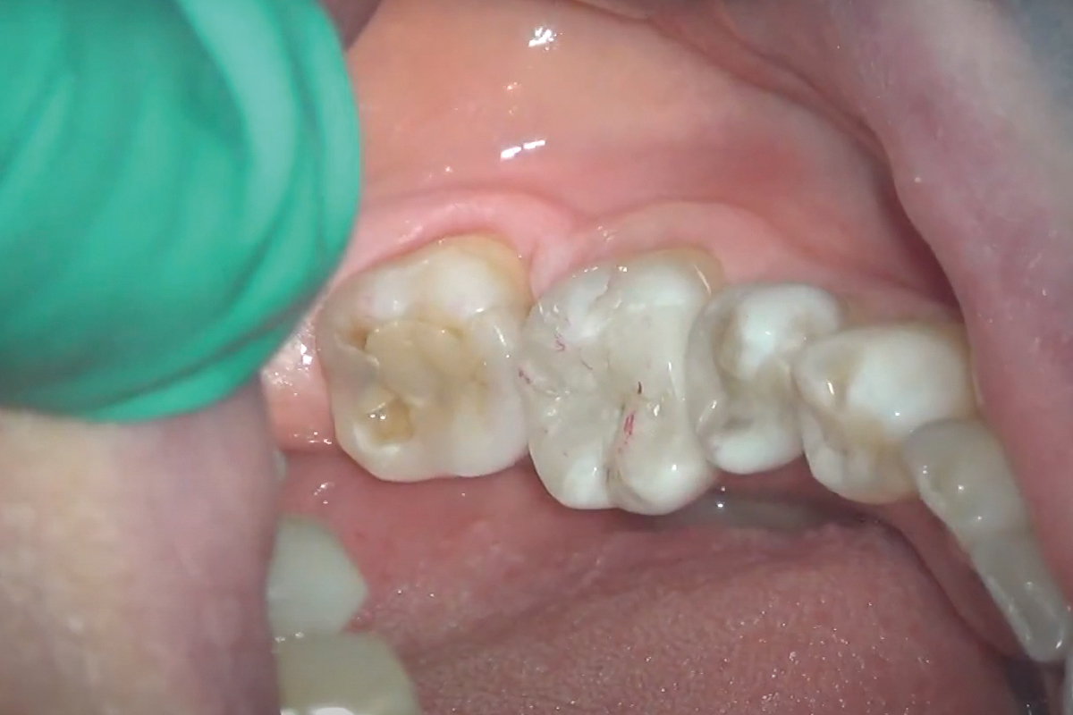 Preparazione e cementazione di un intarsio dentale