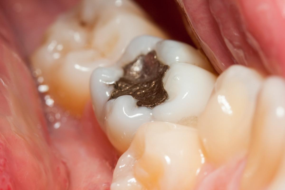 Le otturazioni in amalgama e la sindrome del dente incrinato
